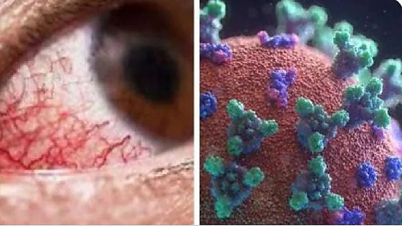 ابنة أول مصابة بالفطر الأسود بــ"مصر" تروي تفاصيل إصابة والدتها واكتشافهم المرض