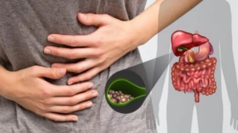 هل يمكن علاج حصوات المرارة بغير الجراحة؟.. طبيب باطنية يُجيب