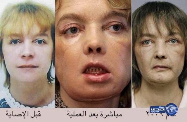 صاحبة أول وجه مزروع في العالم تفارق الحياة.. شاهدوا كيف كان وجهها وكيف أصبح!!