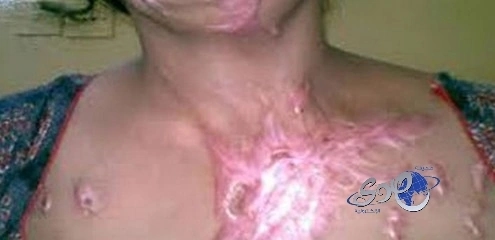 4 شقيقات يتعرضن لهجوم بمادة كاوية في الهند