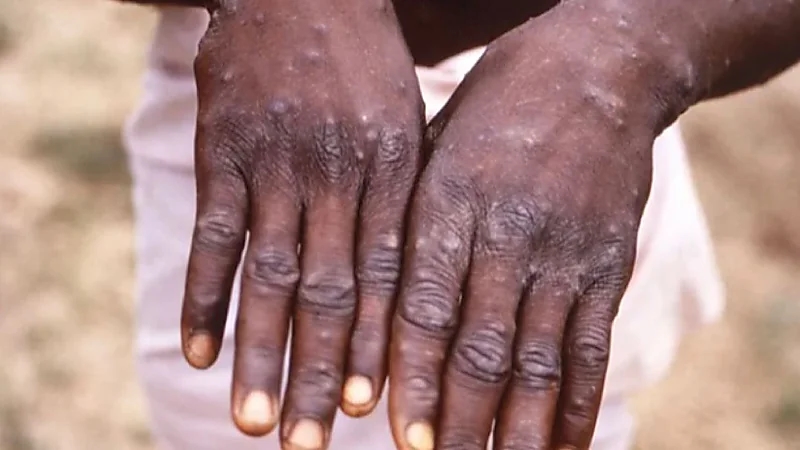 بلجيكا أول دولة تطبق الحجر الصحي ضد جدري القرود