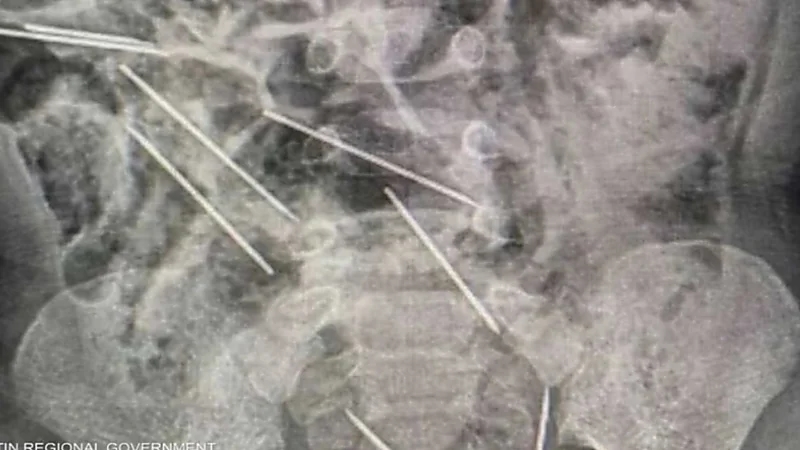 طفل يبتلع 8 إبر حقن مخصصة للحيوانات