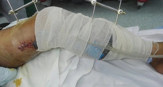 بعد حادث مأسوي .. " سعود الطبية " تنقذ ثلاثيني من بتر قدمه المعلقة بالجلد