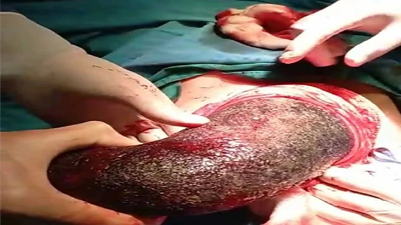 أطباء يسحبون كتلة شعر ضخمة من معدة فتاة