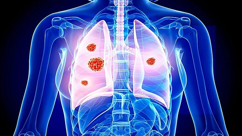 أعراض تشير إلى الإصابة بسرطان الرئة