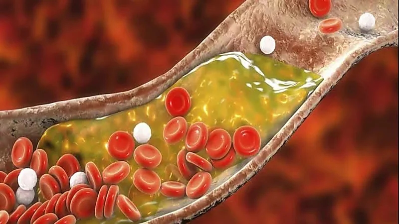 أعراض ارتفاع الكوليسترول في الدم