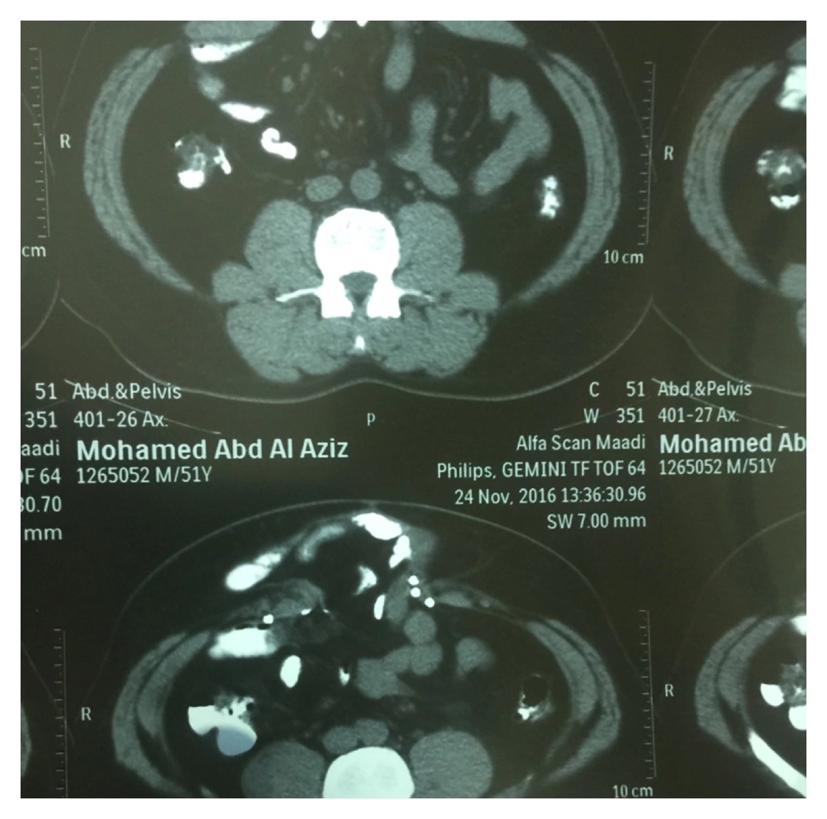فريق طبي ينجح في اجراء عملية جراحية معقدة في مستشفى الفيصل