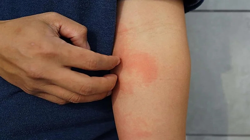 علامات مرئية على الجلد تكشف عن الإصابة بـ"السكري"