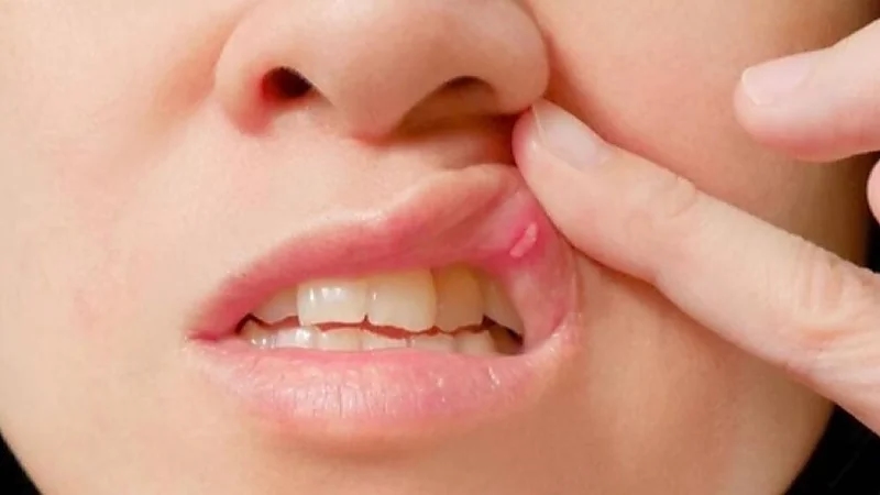 أسباب الإلتهابات والقرحات الدموية بالفم واللسان