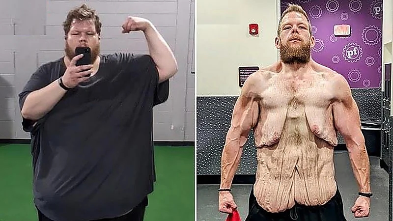 صورة صادمة لأمريكي خسر 152 كجم من وزنه