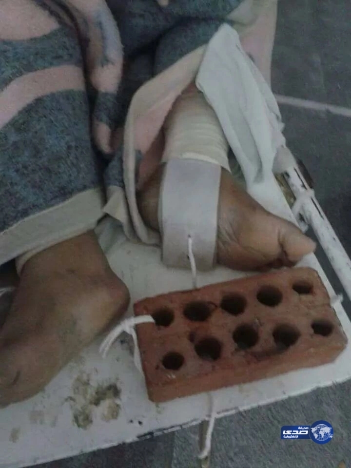 بالصور:كارثة طبية بالقاهرة ..استخدام " قالب طوب " مثبت لجبيرة جبس لمريض