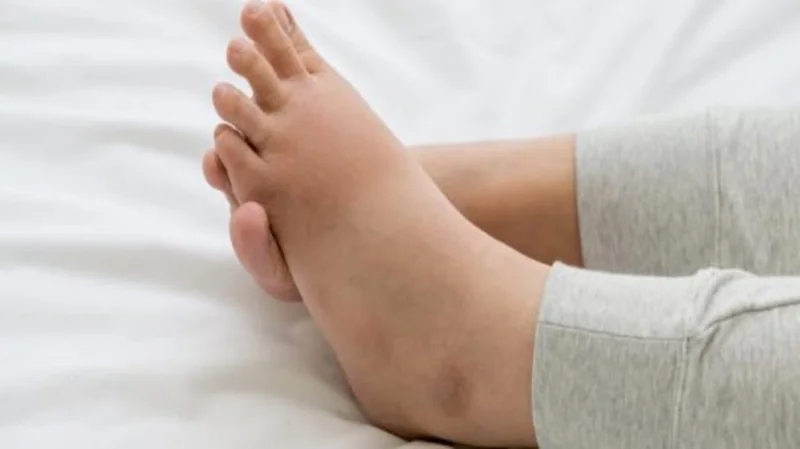 ما هى أسباب انتفاخ الساقين ؟