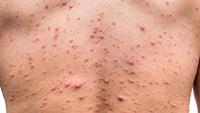 أمريكا تطالب المثليين والمثليات بالتسجيل للحصول على لقاحات جدري القرود