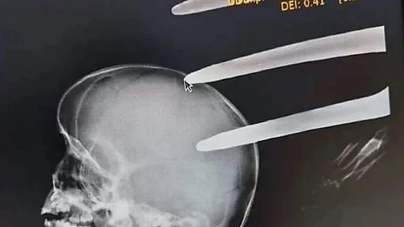 مصرع طفل بـ شوكة في الرأس أثناء لعبه