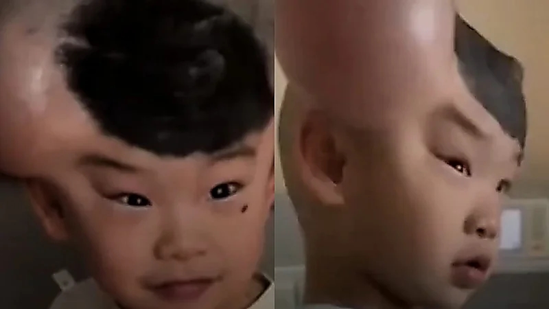 طفل صيني يُلقب بـ ميكي ماوس بسبب وحمتين نادرتين على رأسه .. فيديو
