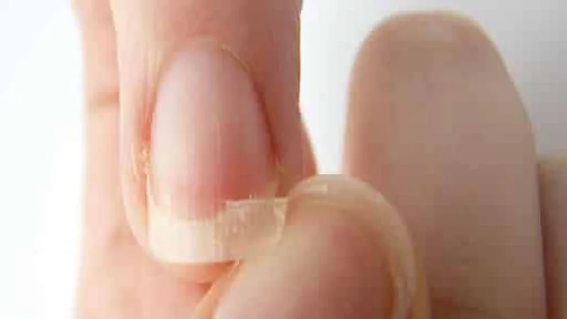 علامات نقص الحديد بالجسم