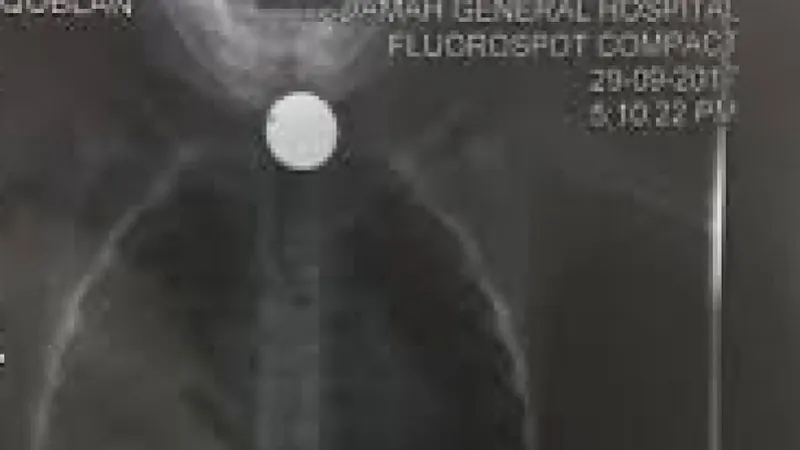 انقاذ حياة طفل ابتلع بطارية و14 قطعة لأجسام مختلفة توقفت بالمريء في نجران