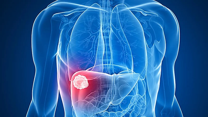 علامات عادية تنبهك بالإصابة بسرطان الكبد