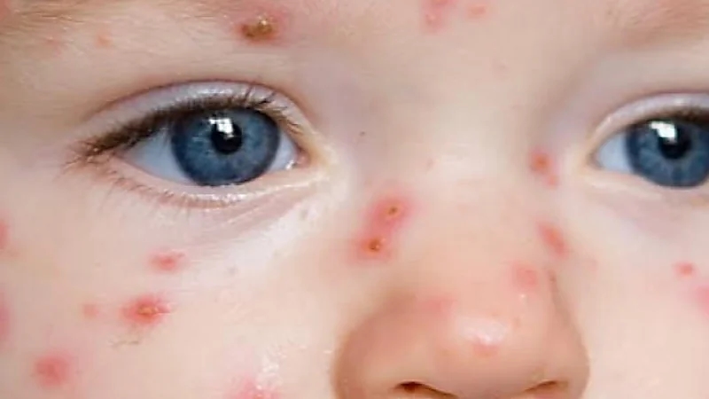 أسباب وأعراض مرض الشرى عند الأطفال