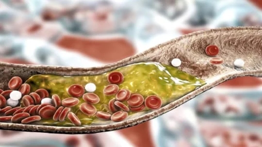 رائحة كريهة.. علامة خطيرة لارتفاع نسبة الكوليسترول في الدم