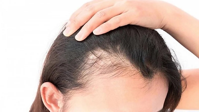 دراسة تكشف عصير طبيعي زهيد الثمن يعالج تساقط الشعر في أسبوعين