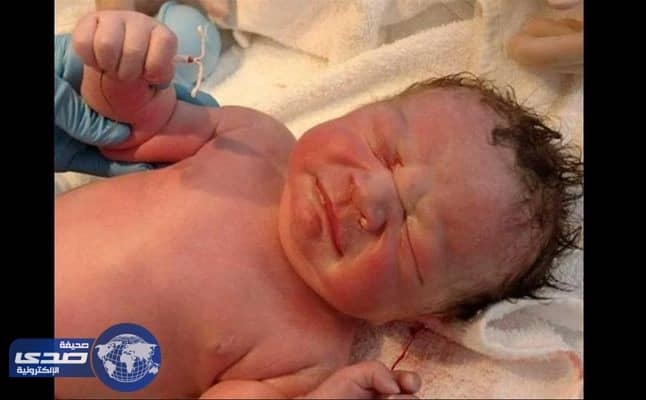 بالصورة.. رضيع يحمل بيده " لولب " فور ولادته