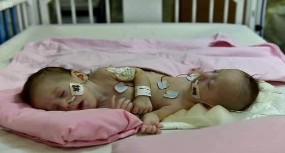 الأحد.. إجراء عملية فصل التوأمين السياميين " فرح وحنين "