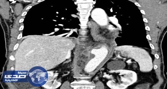 فريق طبي يُنقذ حياة خمسيني ويستبدل شريانه الأورطي بآخر صناعي