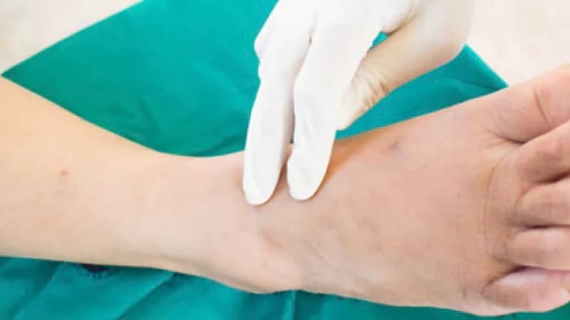 طرق مختلفة لعلاج القدم السكري