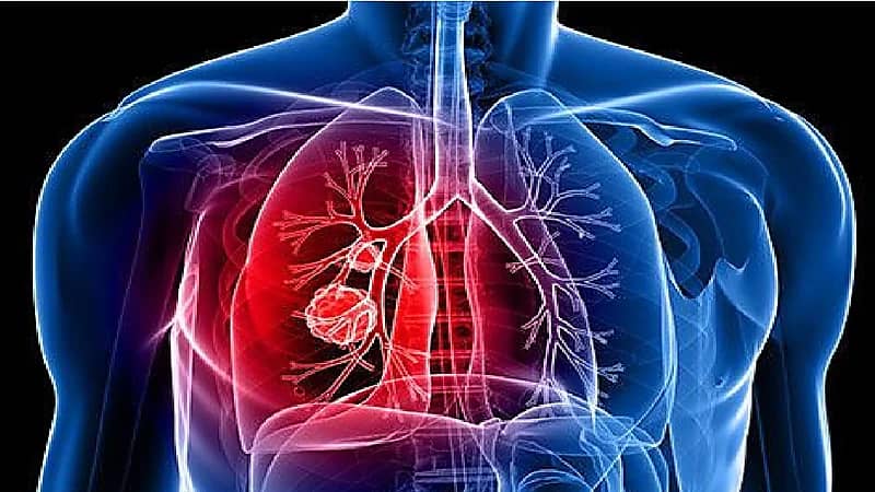 علامات تحذيرية تنذر بالإصابة بسرطان الرئة
