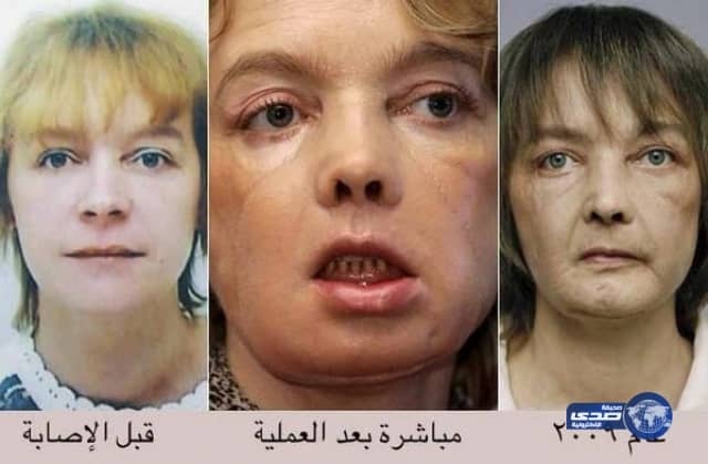 صاحبة أول وجه مزروع في العالم تفارق الحياة.. شاهدوا كيف كان وجهها وكيف أصبح!!