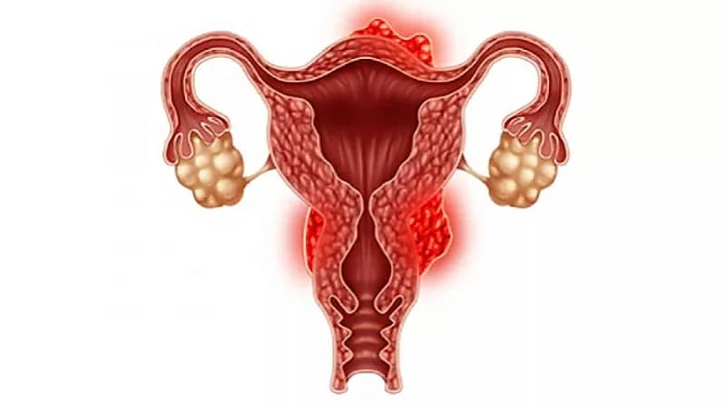 خطورة سرطان الرحم وأعراضه لدى النساء والفتيات