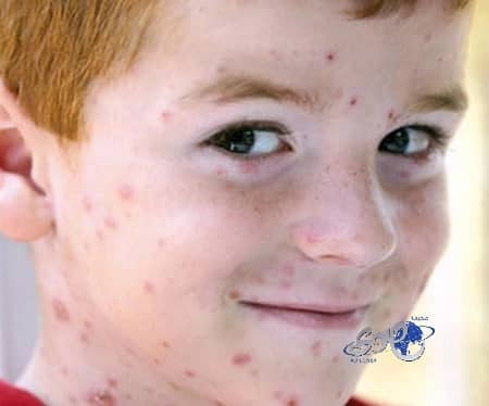 "العنقز".. يضعف المناعة وينقل "العدوى" للملازمين