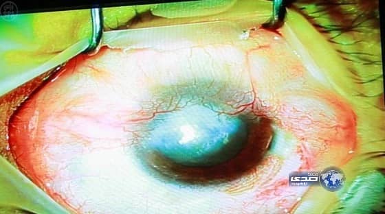 مستشفى الملك خالد للعيون يجري أول ثلاث عمليات لزراعة الخلايا الجذعية بالقرنية