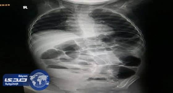 فريق طبي بعفيف ينجح في إعادة ترميم أمعاء طفل متهتكة