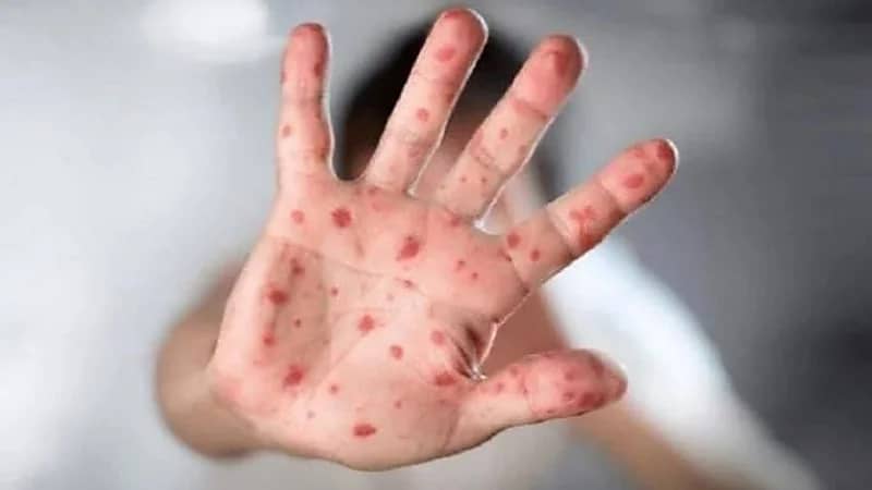 بالفيديو.. استشاري يوضح الفرق بين جدري القردة وجدري الماء