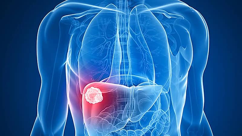 علامات في البطن تشير إلى الإصابة بسرطان الكبد