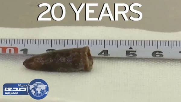 بالفيديو.. استخراج غطاء قلم بقي في رئة شاب 20 عاماً