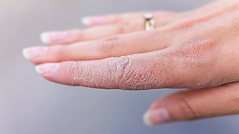 بالفيديو .. علامات تنذر بنقص الزنك في الجسم