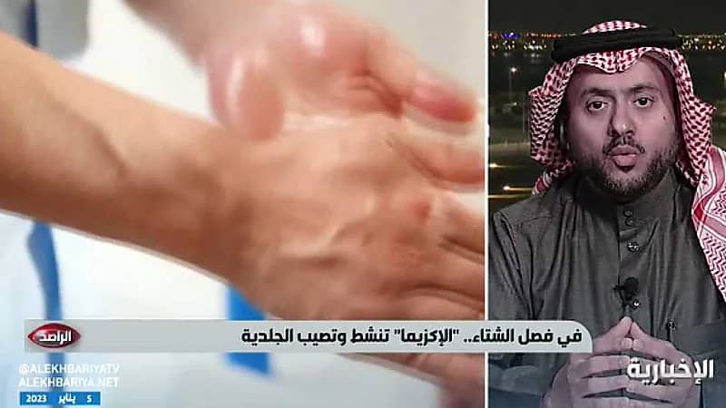 "استشاري" يوضح أبرز السلوكيات الخاطئة التي تضر مرضى الإكزيما خلال فصل الشتاء (فيديو)