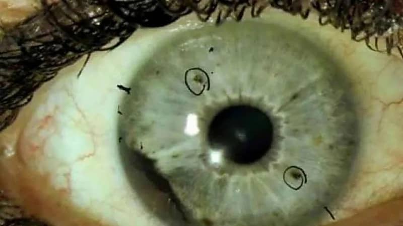 مصر تحذر من استخدام المضادات الحيوية بعد ظهور  3 إصابات بالفطر الأسود  