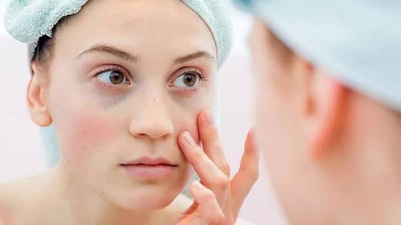 أسباب توسع الشعيرات الدموية في الوجه