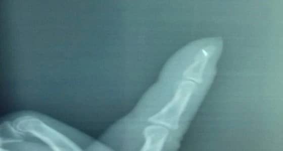 استخراج إبرة خياطة من يد امرأة لازمتها 40 عاما في مهد الذهب