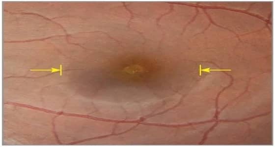 كشف تفاصيل أول صورة لشبكية عين محترقة بسبب كسوف الشمس