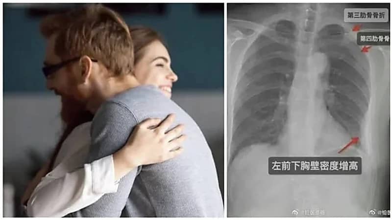 امرأة تقاضي رجلًا تزعم أنه كسر ضلوعها خلال "عناق"