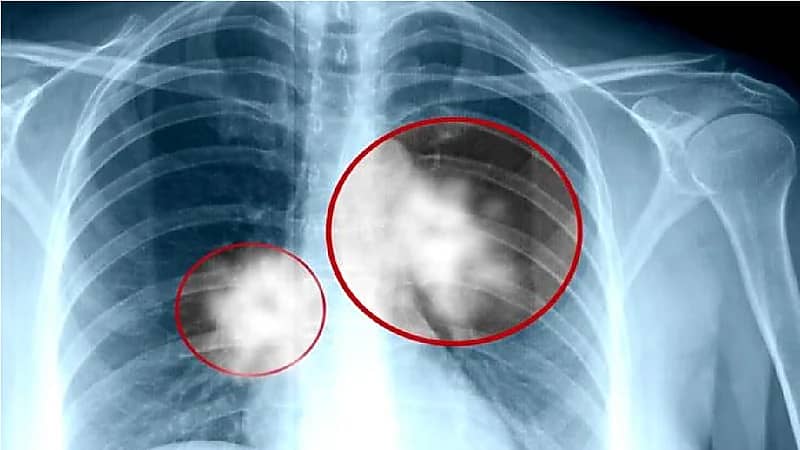 بالفيديو .. رحلة علاج مواطن اكتشف إصابته بالسرطان في يوم زفاف ابنته