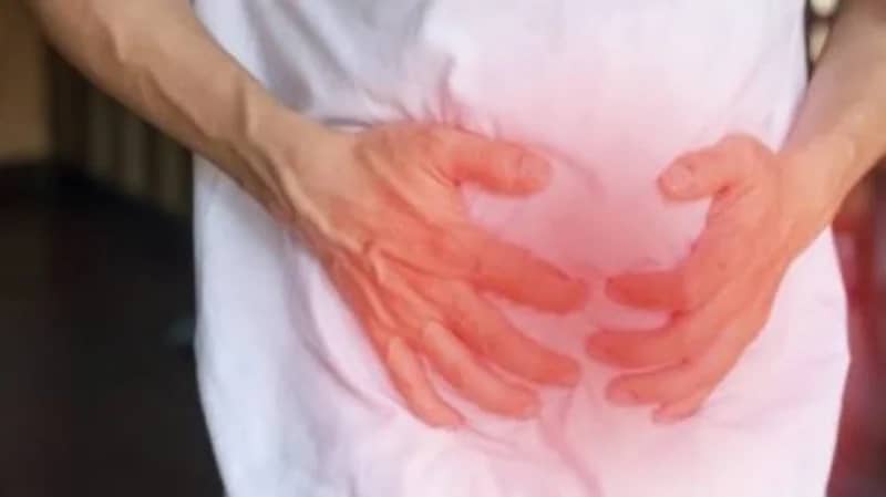 الذيابي يوضح أعراض مرض كرونز