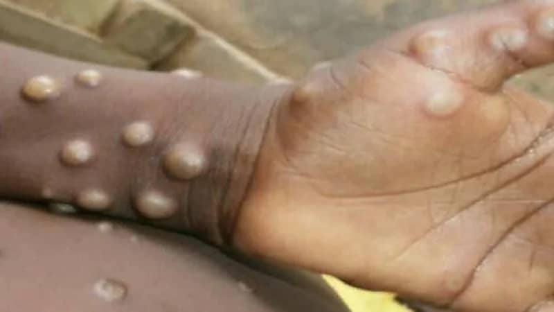 انتشار جدري القردة في كافة الولايات الأمريكية