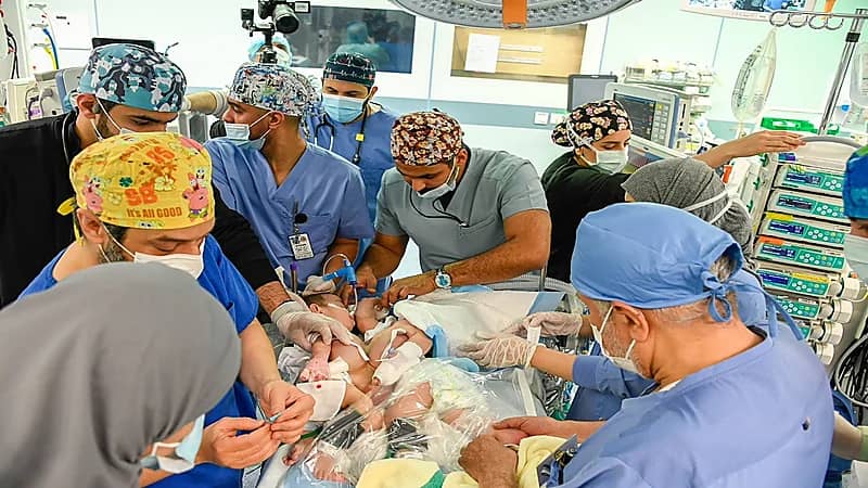 بالفيديو .. نجاح فصل التوأم السيامي العراقي "عمر" و"علي" وبدء عملية الترميم