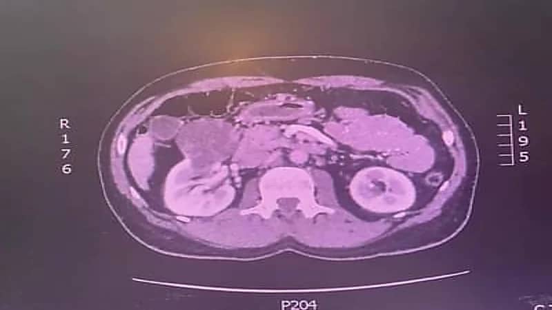 استئصال ورم كلوي لمريض خمسيني في الطائف 